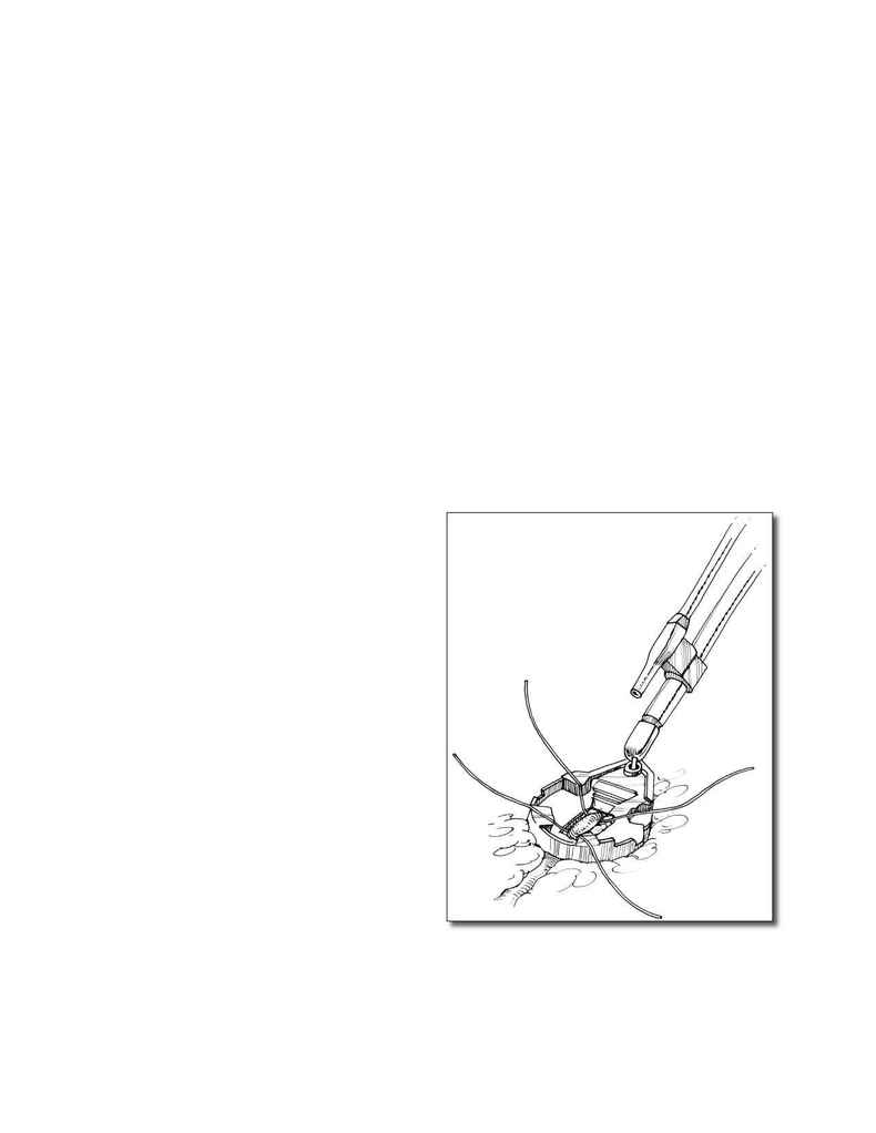 Mitral Valve Surgery - JLT 1306(206)